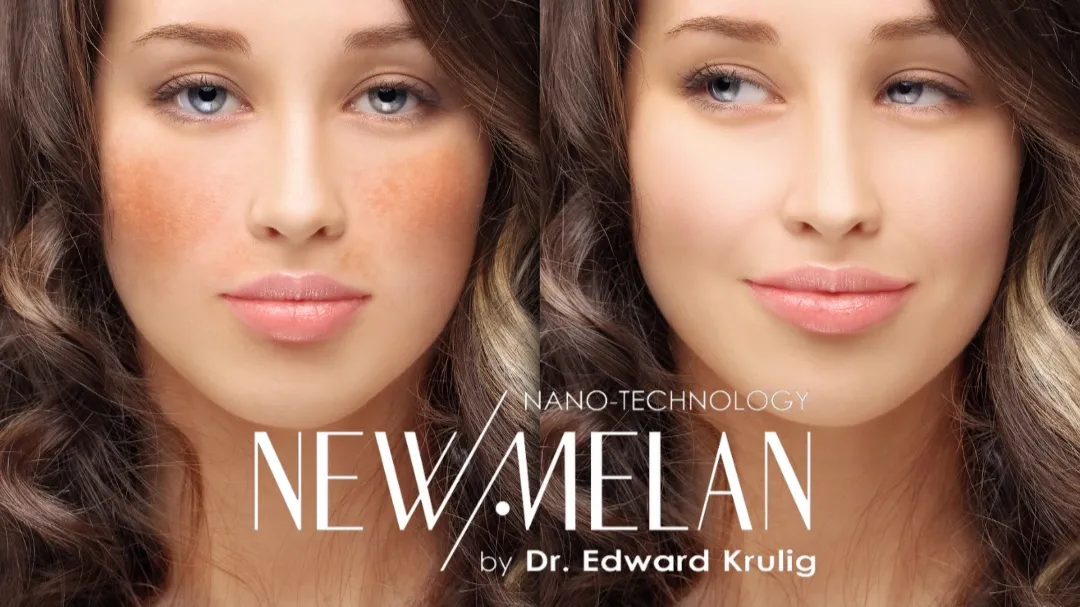 Fisiopatología del Melasma